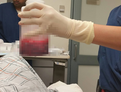 หนุ่มอยากผงาดนาน ฉีดยาโด๊ปเข้านกเขา เจ้าโลกบวมเป่งแทบระเบิด