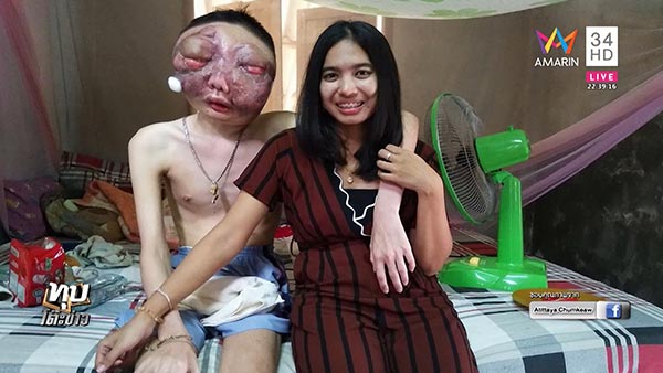 มะเร็งที่ตา