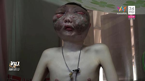 มะเร็งที่ตา