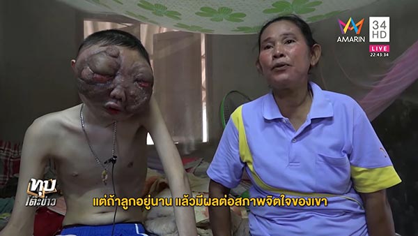 มะเร็งที่ตา