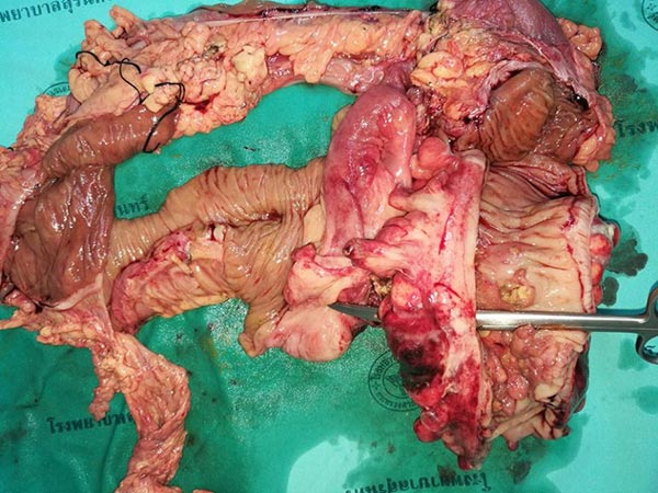 ลำไส้ผู้ป่วยมะเร็ง