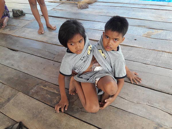 แฝดสยาม