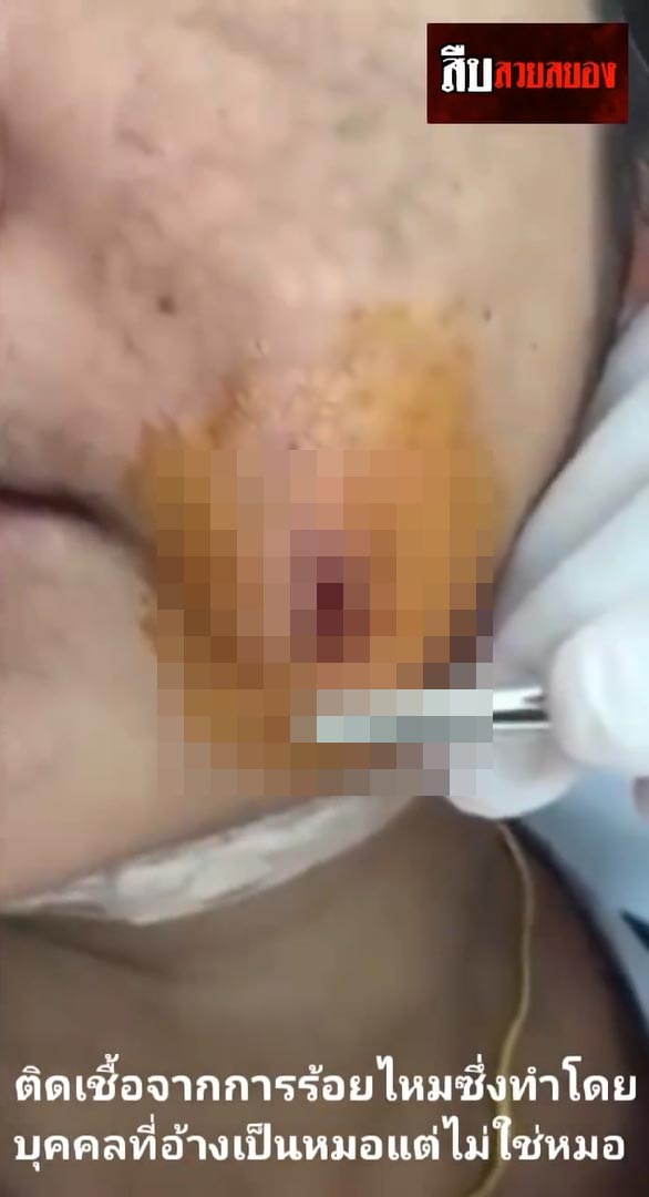 หมอเถื่อน