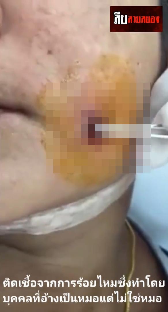 หมอเถื่อน