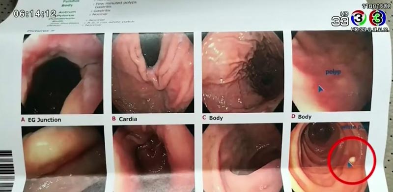 เชื้อเอชไพโลไร