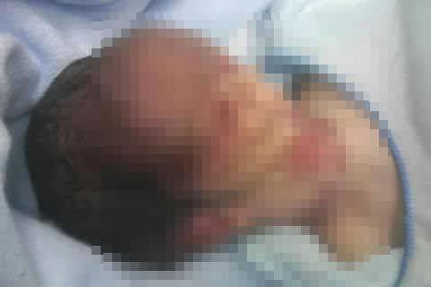 หมอทำคลอดทารกหัวขาด