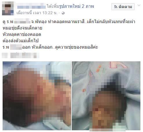 หมอทำคลอดทารกหัวขาด