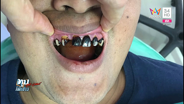 เคี้ยวหมาก