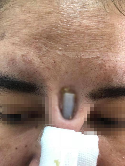 ศัลยกรรมจมูก