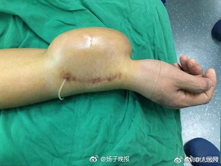 ปลูกถ่ายอวัยวะ