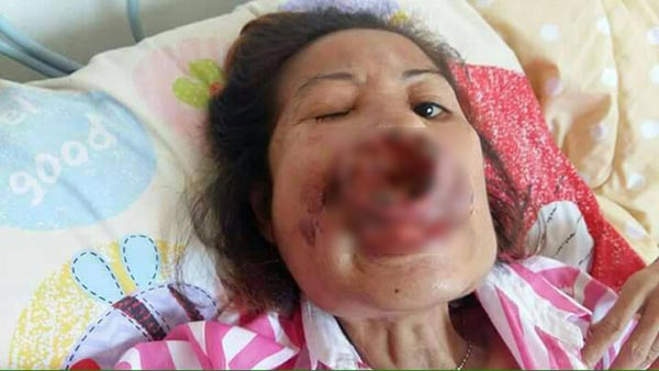 มะเร็งช่องปาก