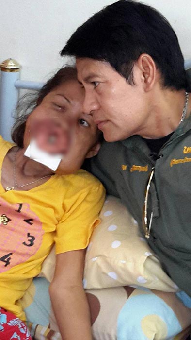 มะเร็งช่องปาก