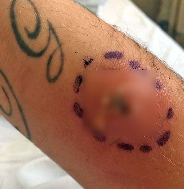 พิษแมงมุมแม่ม่าย