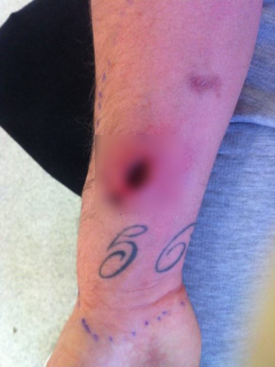 พิษแมงมุมแม่ม่าย