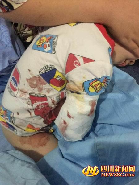 เด็กถูกขย้ำแขนขาด