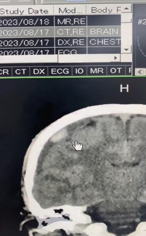 ผ่าตัดสมอง