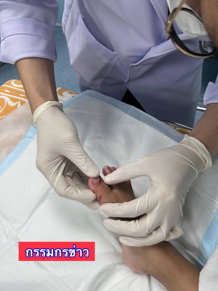 เท้าติดบันไดเลื่อน