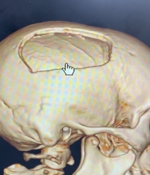 ผ่าตัดสมอง