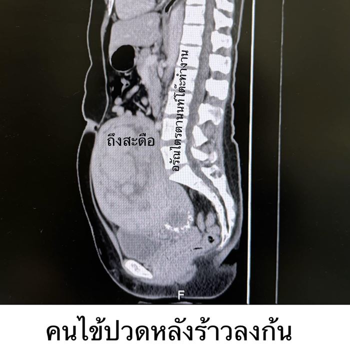 แม่ค้าปวดหลังบริเวณก้นกบ ร้าวนาน 2 ปี พอไปตรวจหมอคิดว่าท้อง 5 เดือน ทั้งที่ไม่มีสามี