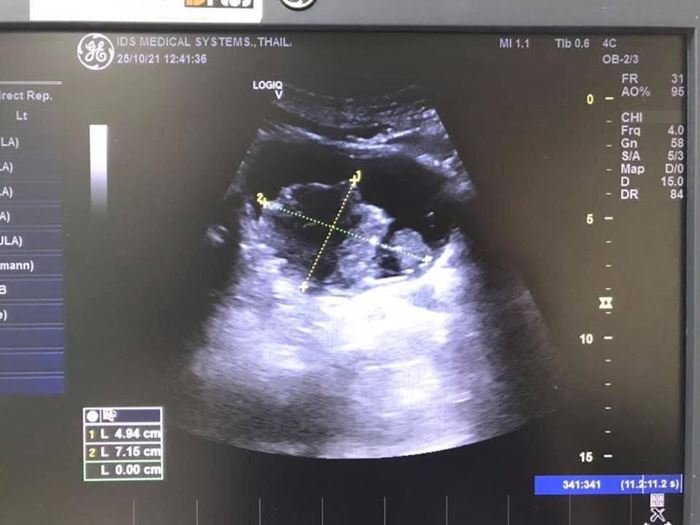 มะเร็งกระเพาะปัสสาวะ เผยสูบบุหรี่ตั้งแต่อายุ 15 ปี