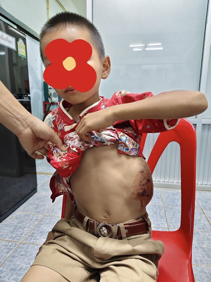 เด็กชาย ป.2 ป่วยมีก้อนเนื้อขนาดใหญ่ แต่ไม่กล้าบอกใคร หวั่นไร้เงินรักษา เด็กชาย ป.2 ป่วยมีก้อนเนื้อขนาดใหญ่ แต่ไม่กล้าบอกใคร หวั่นไร้เงินรักษา