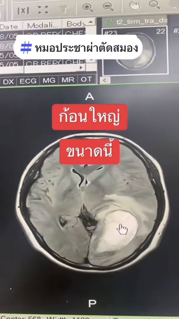 มะเร็งปอดระยะสุดท้าย ผลจากการรับบุหรี่มือ 2