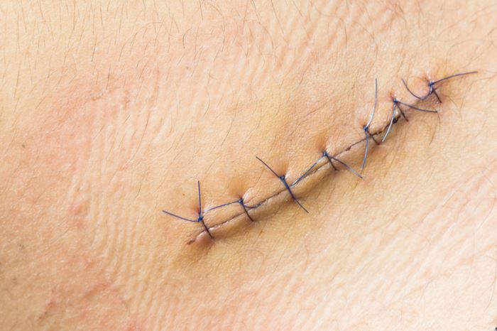 แม่อยากตบพยาบาล ลูกไส้ติ่งแตกแต่ไม่เย็บแผล