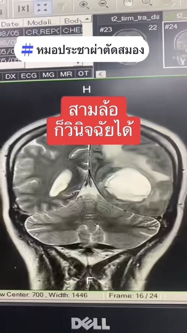 มะเร็งปอดระยะสุดท้าย ผลจากการรับบุหรี่มือ 2