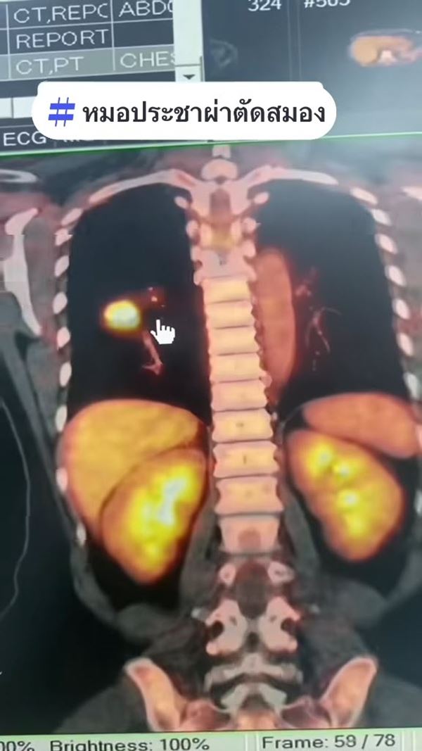 มะเร็งปอดระยะสุดท้าย ผลจากการรับบุหรี่มือ 2