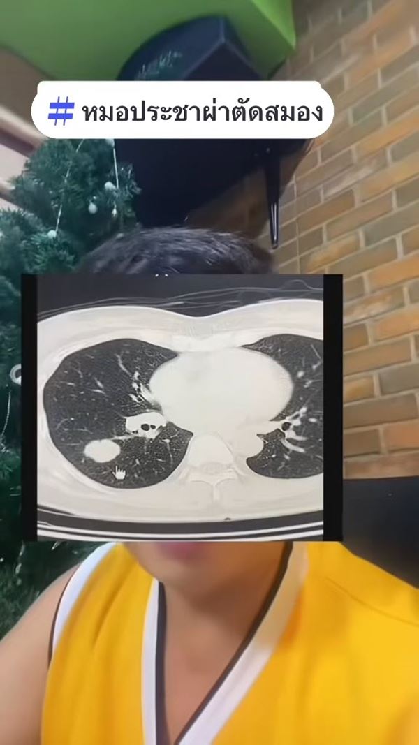 มะเร็งปอดระยะสุดท้าย ผลจากการรับบุหรี่มือ 2