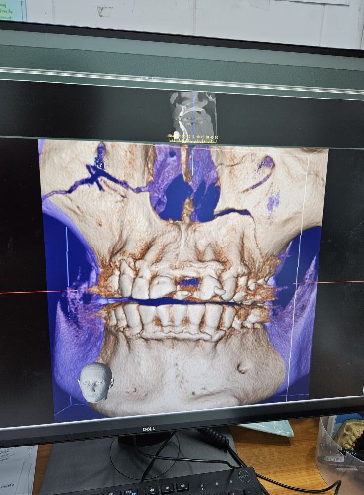 หมู วรวุฒิ ปั่นจักรยานวูบ เจ็บหนักเพราะภาวะน้ำตาลหมด