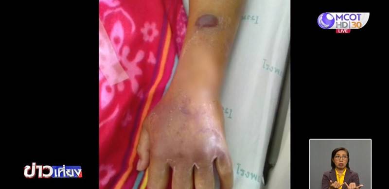 แมงมุมกัด