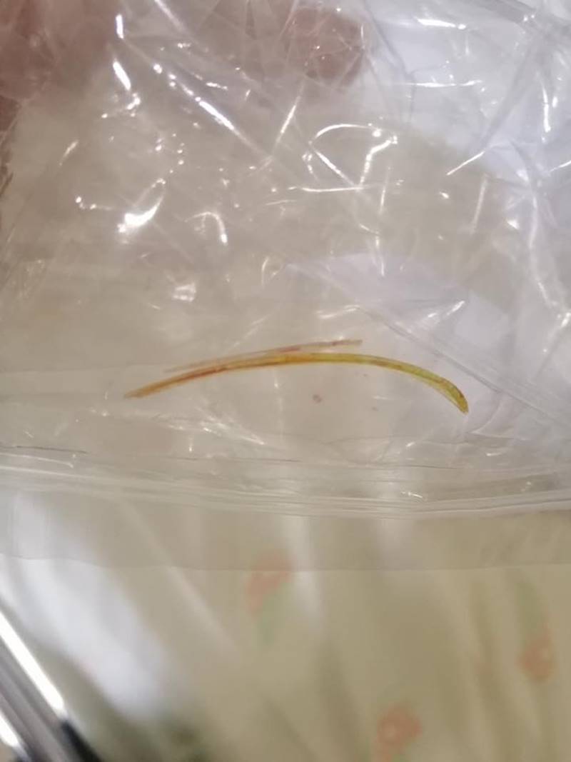 ก้างปลาทิ่มลำไส้ 