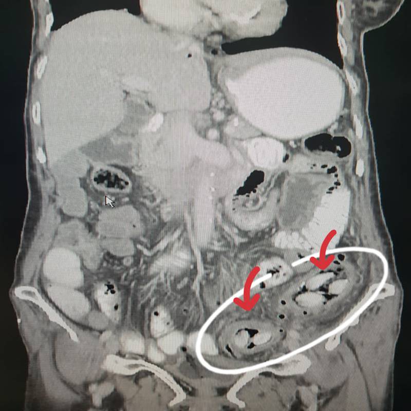 เม็ดกระท้อน