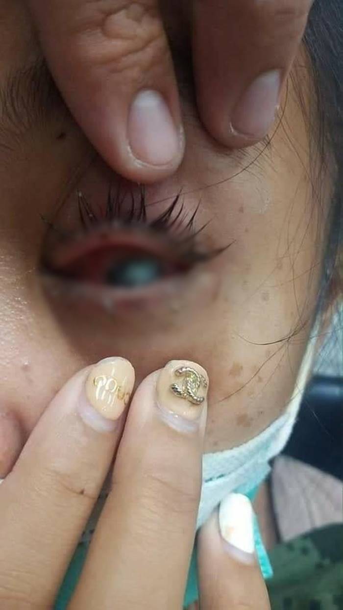 คอนแทคเลนส์