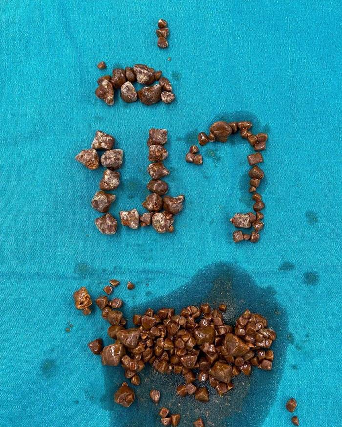 นิ่วในถุงน้ำดี