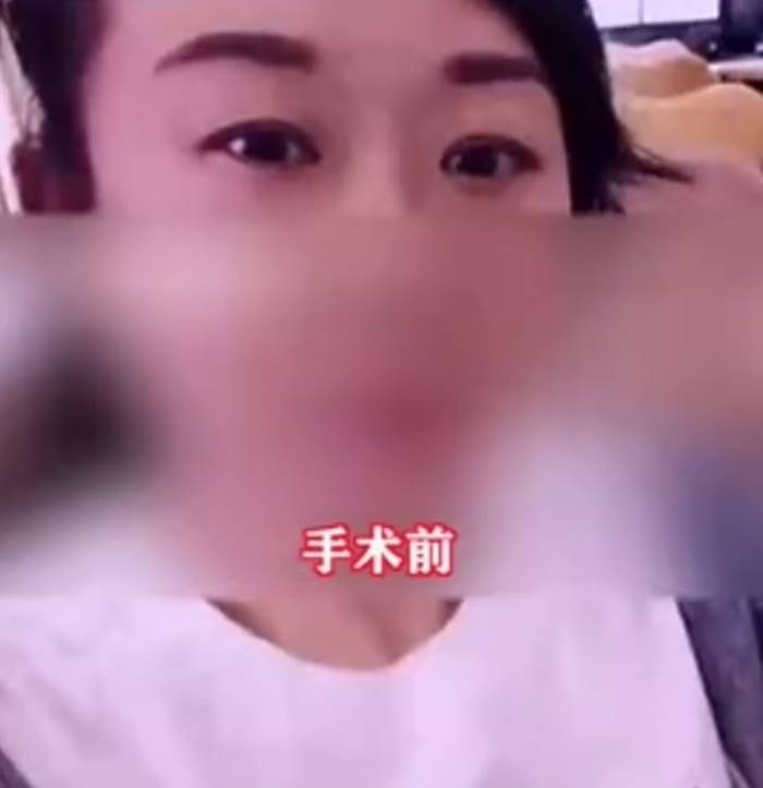 ศัลยกรรม, ทำตา 2 ชั้น