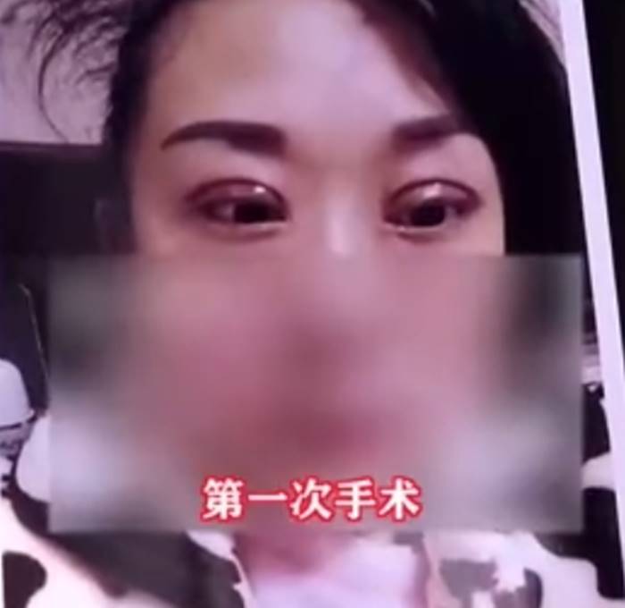 ศัลยกรรม, ทำตา 2 ชั้น