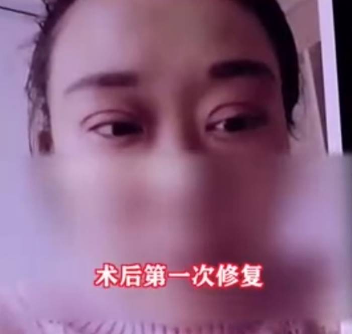 ศัลยกรรม, ทำตา 2 ชั้น