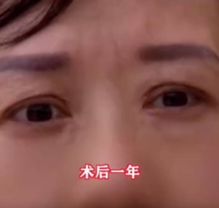 ศัลยกรรม, ทำตา 2 ชั้น