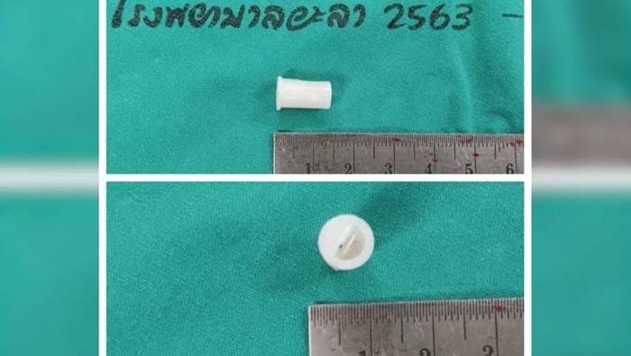 นกหวีดติดคอ