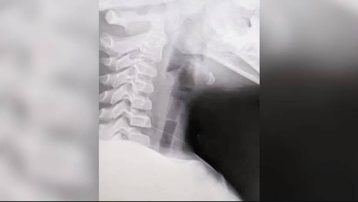 นกหวีดติดคอ