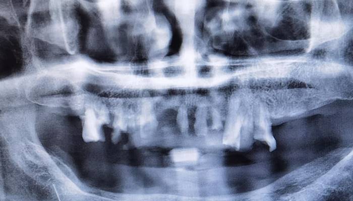 ฟันปลอมเถื่อน