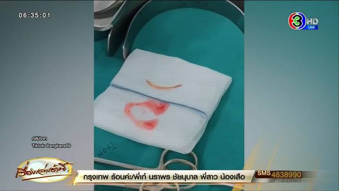 ก้างปลาทะลุลำไส้