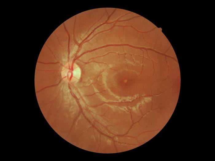 เลเซอร์เข้าตา