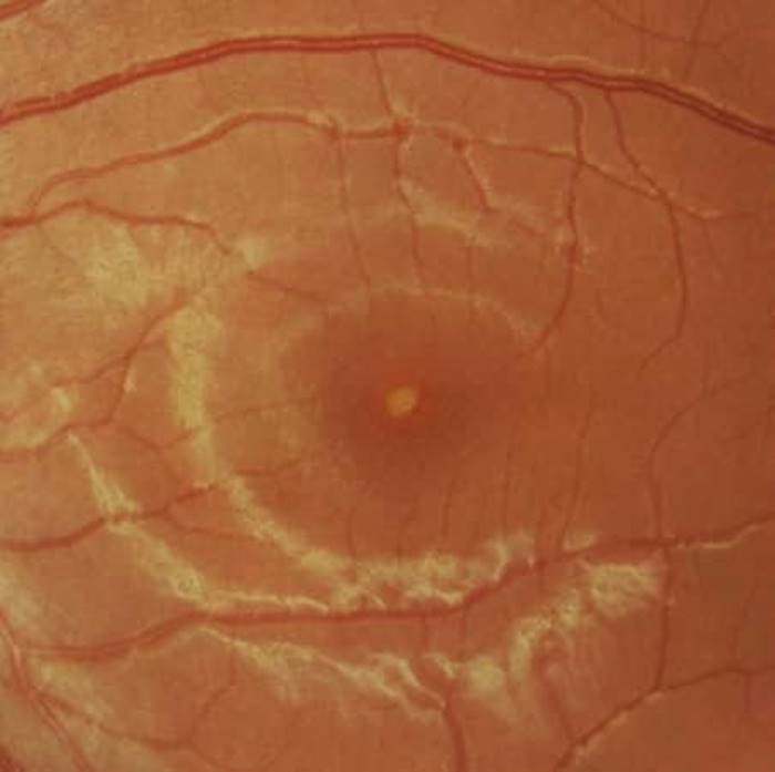 เลเซอร์เข้าตา