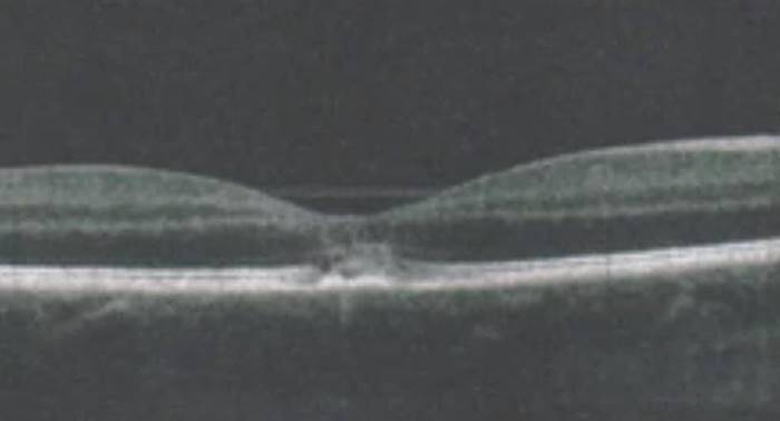 เลเซอร์เข้าตา