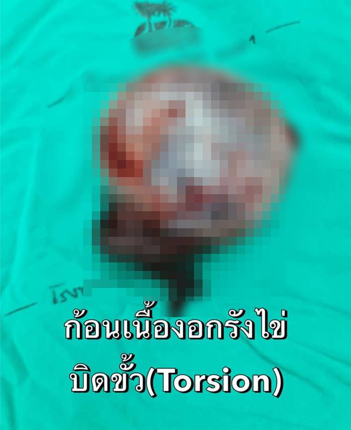 ผ่าตัดเนื้องอกในรังไข่