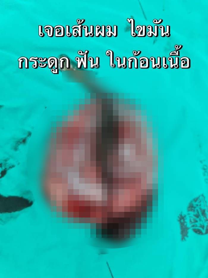 ผ่าตัดเนื้องอกในรังไข่