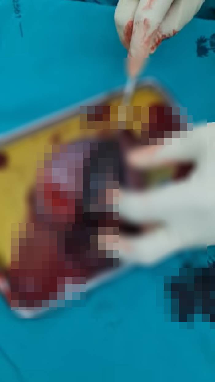 ผ่าตัดเนื้องอกในรังไข่